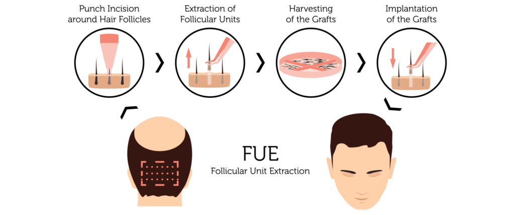 Follicular Unit Extraction (FUE)