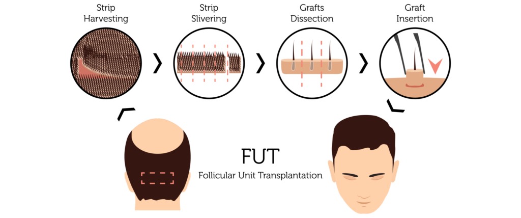 Follicular Unit Transplantation (FUT)