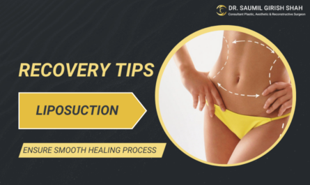 Liposuction Recovery Tips: How to Ensure a Smooth Healing Process