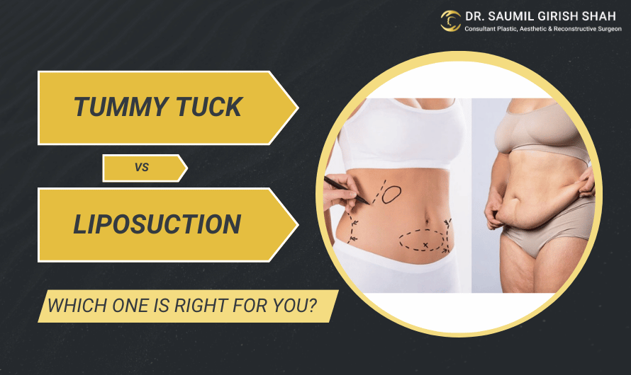 Tummy Tuck vs. Liposuction: Which One Is Right for You?