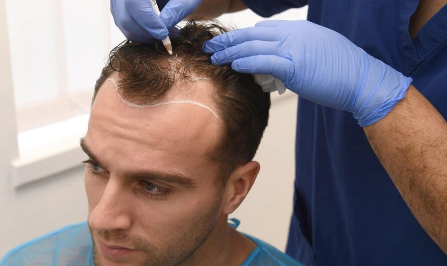 Benefits of Hair Transplant