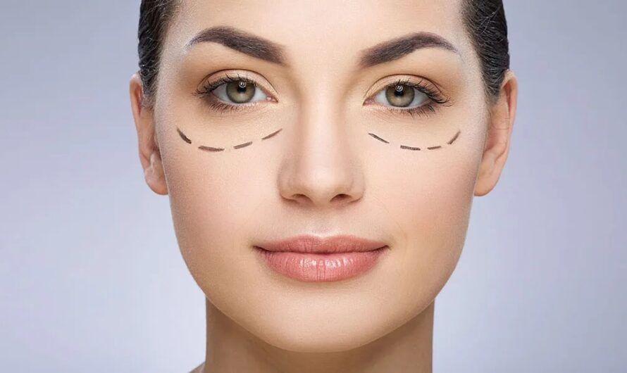 How Long Does Blepharoplasty Last?