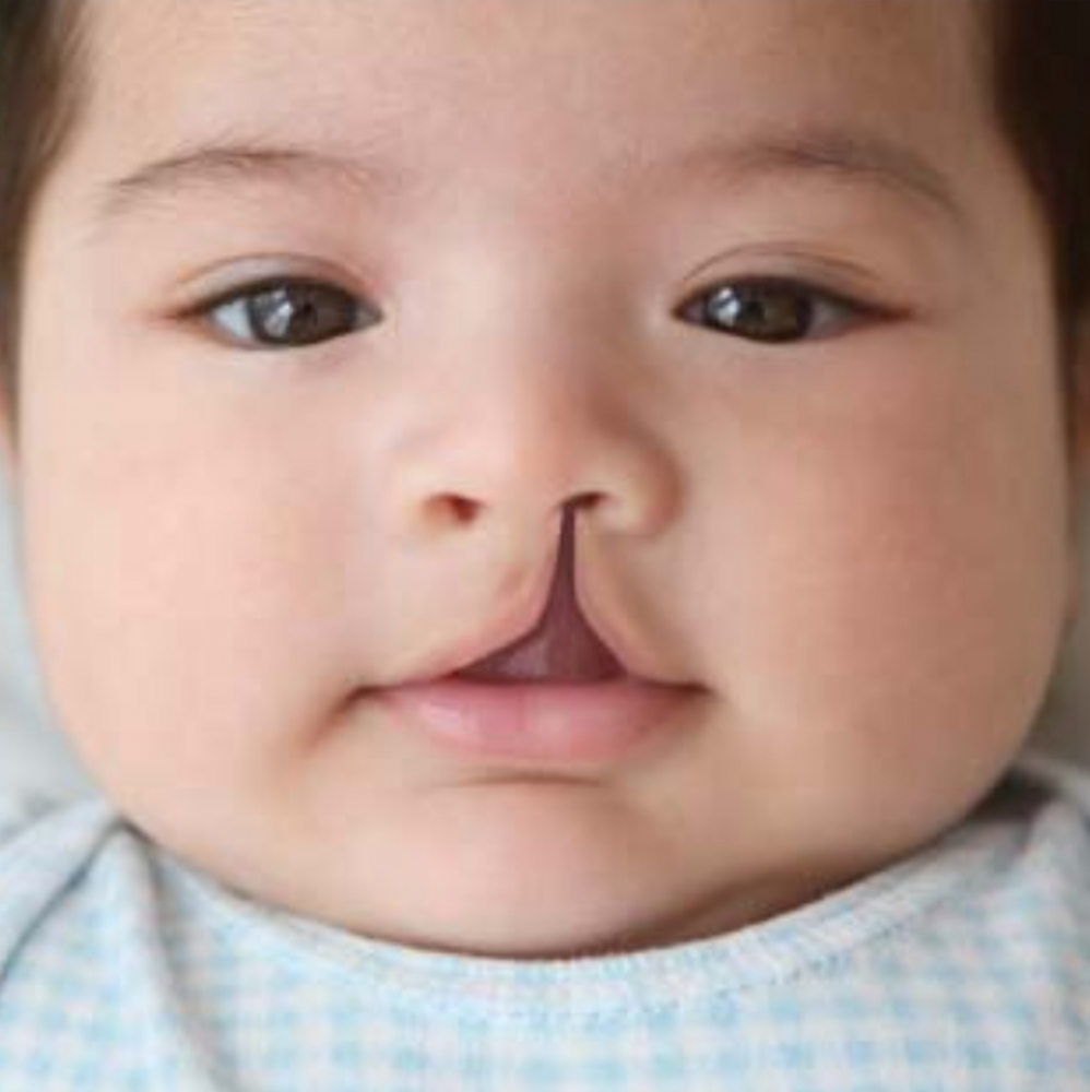 Cleft Lip and Palate