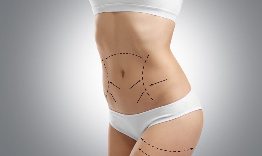 Diet and Exercise After Tummy Tuck Surgery: Maintaining Your Results