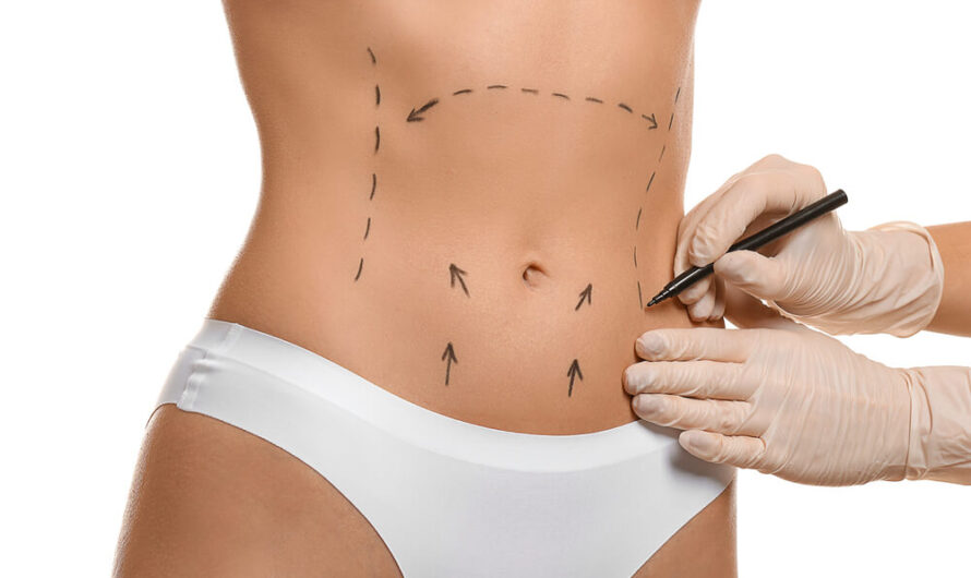 Tummy Tuck Scars: What to Expect and How to Minimize Them