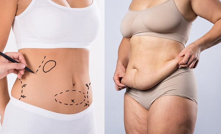 Tummy Tuck vs. Liposuction: Which One Is Right for You?