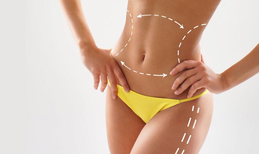 Liposuction Recovery Tips: How to Ensure a Smooth Healing Process