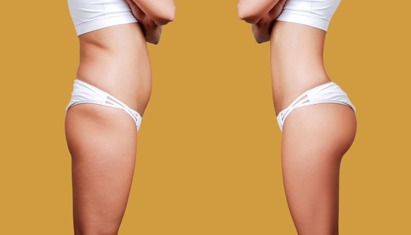 Buttock Augmentation