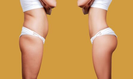 Buttock Augmentation