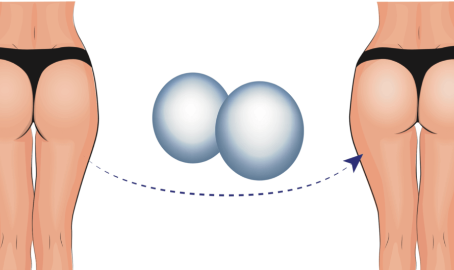 Buttock Implants vs. Brazilian Butt Lift: Which Is Better?