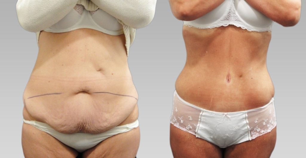 Full Tummy Tuck