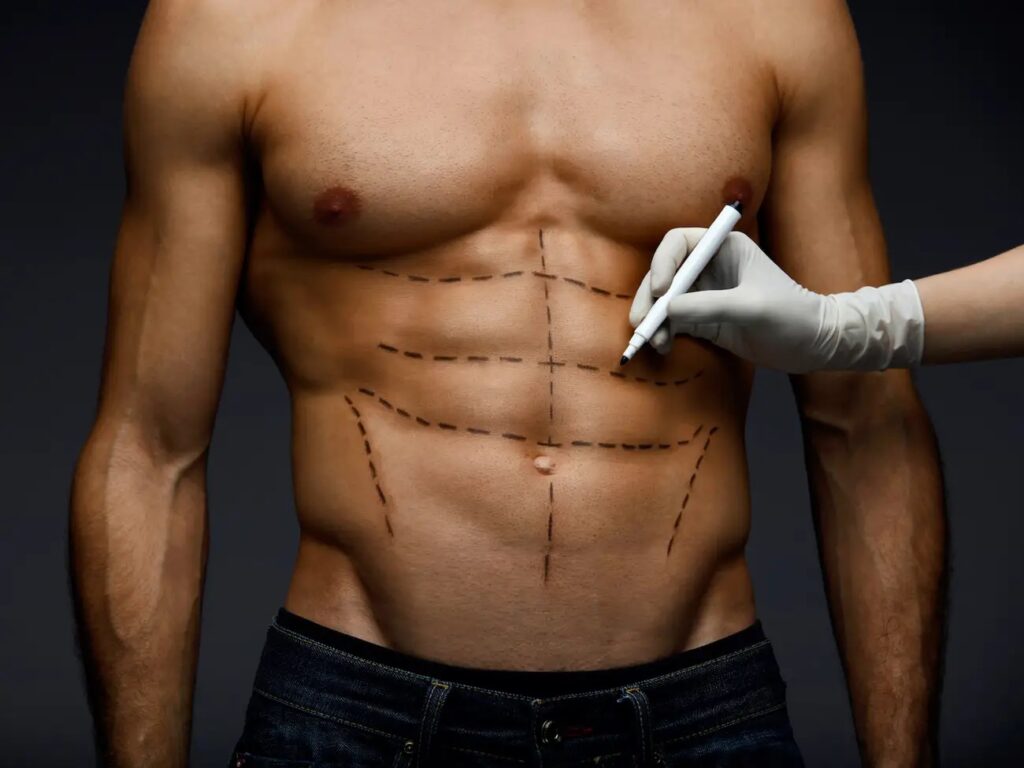 Liposuction