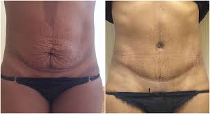 Mini Tummy Tuck