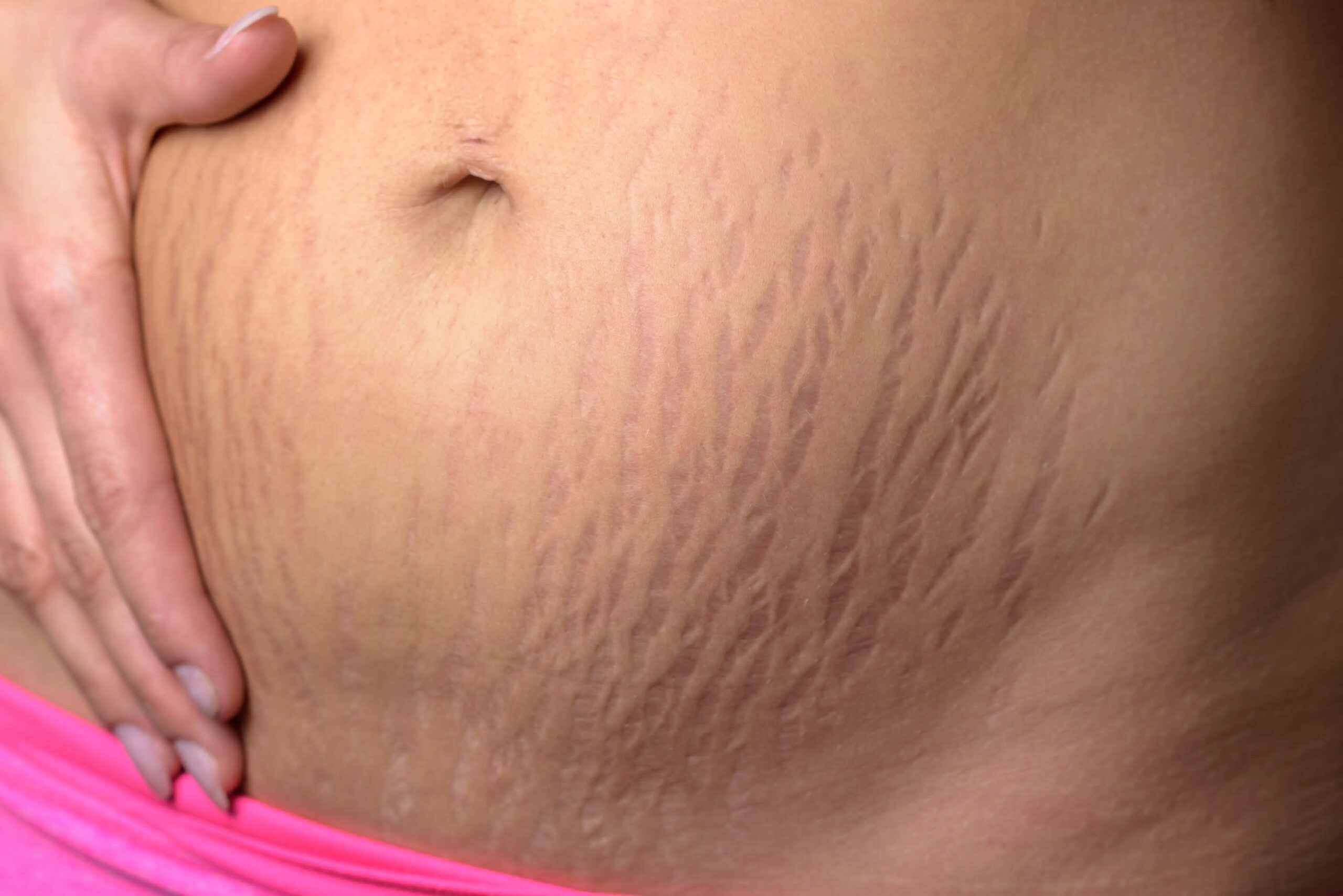 Stretch Marks Reduction