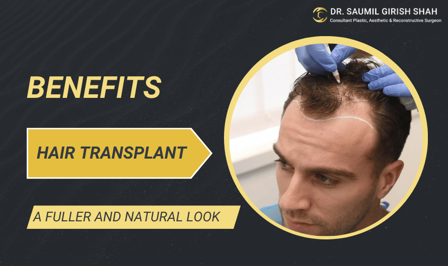 Benefits of Hair Transplant