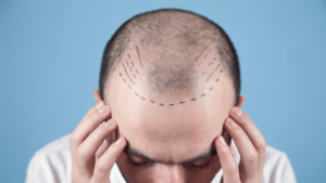 Understanding Hair Transplants