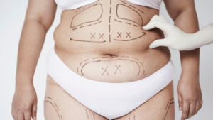 Understanding the Basics: Liposuction vs. Weight Loss