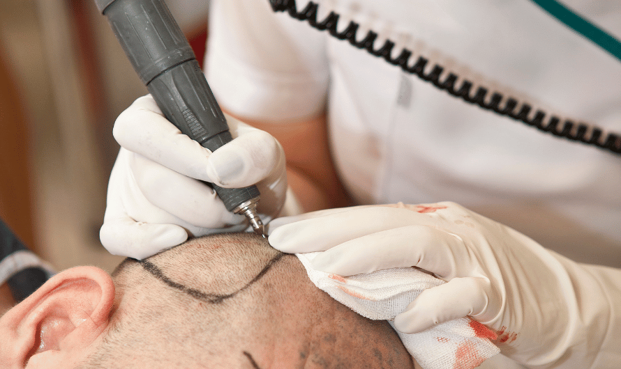 Hair transplant with Dr. saumil Sha