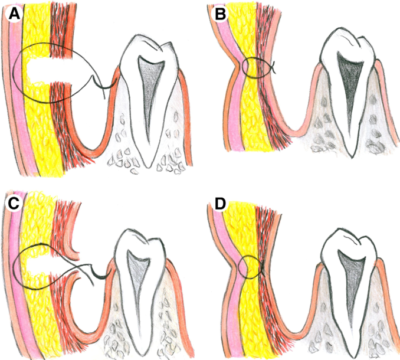 Dimple Surgery Procedure Step by Step
