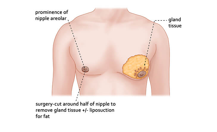 What is Gynecomastia?