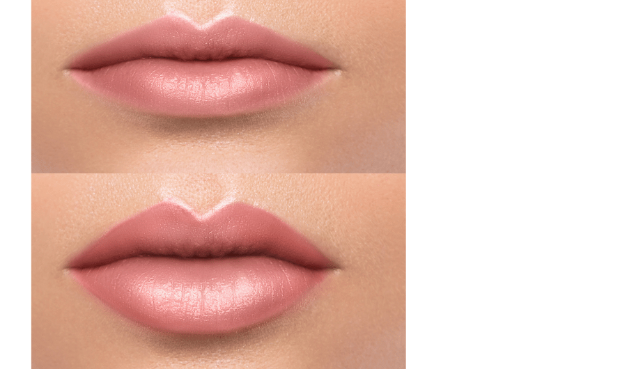 Lip Augmentation before after