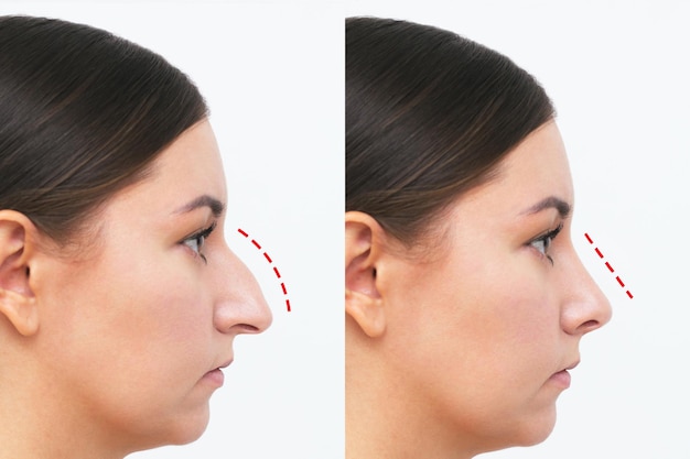 Rhinoplasty