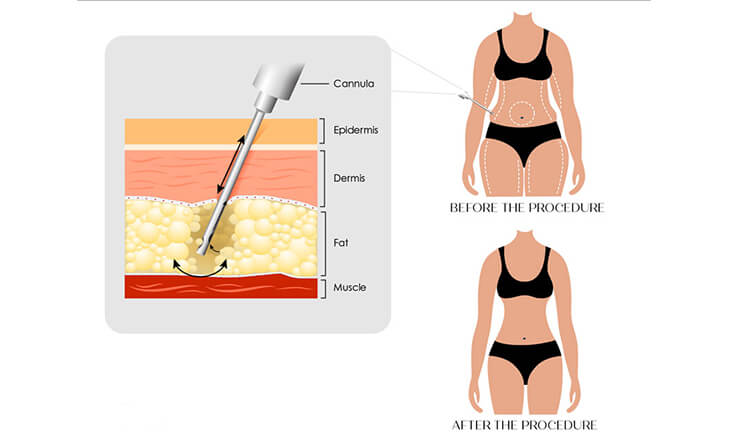 The Treatment Process: 360 Liposuction
