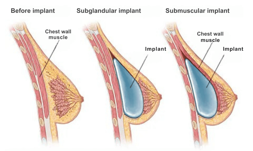 What Is Breast Augmentation or Mammoplasty?