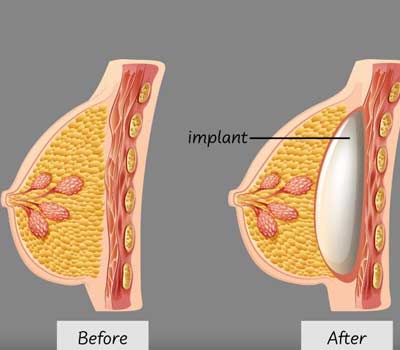 Average Cost of Breast Augmentation in India