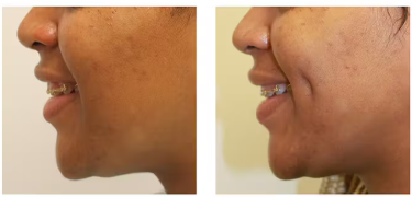 Understanding Dimple Surgery