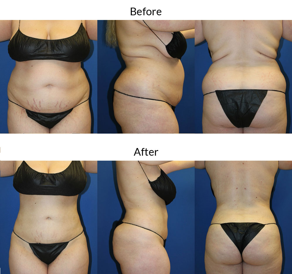 360 Liposuction