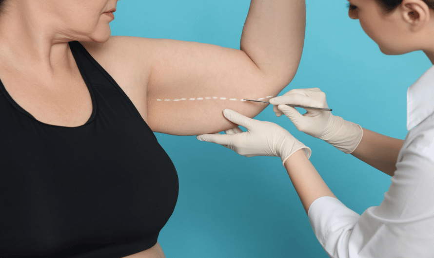 Arm Liposuction treatment with Dr. Saumil Shah
