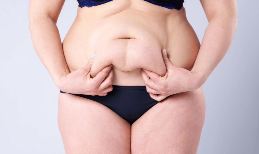 Tummy Tuck by Dr Saumil Shah