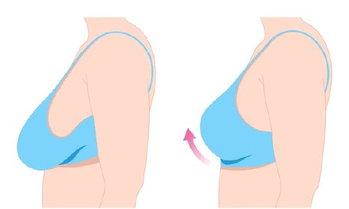 breast lift surhry