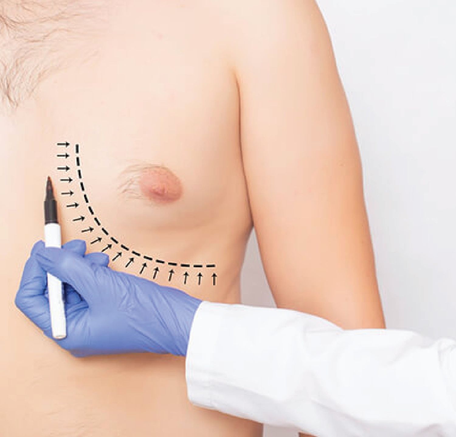 Latest Techniques in Gynecomastia Surgery (2025)