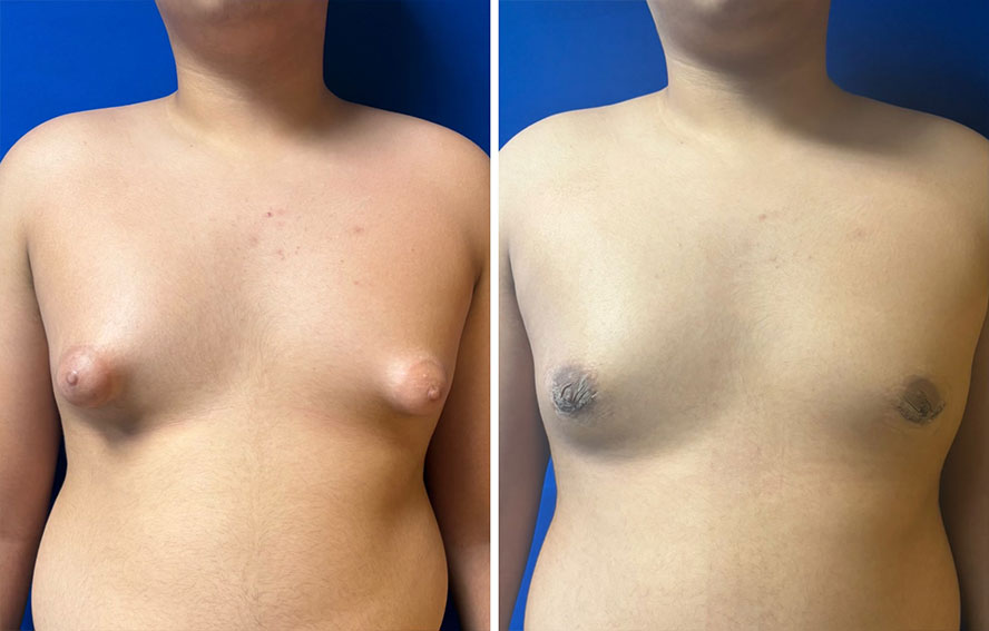 Benefits of Gynecomastia Surgery in mumbai with Dr. Saumil Shah