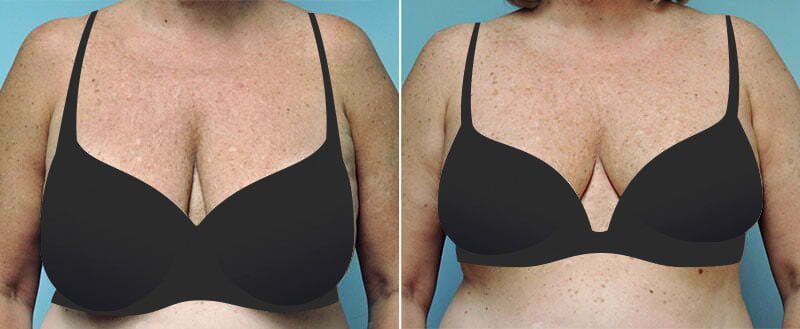 The Breast Reduction Procedure in Mumbai