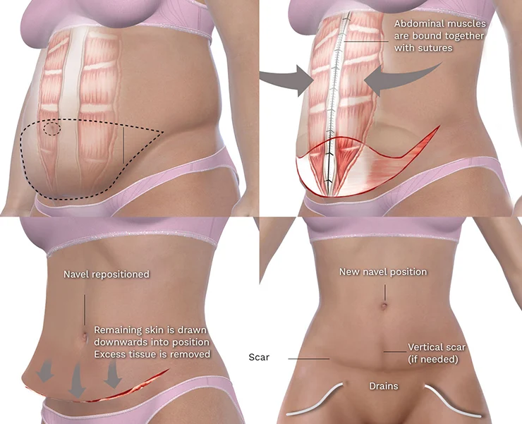 Is a Tummy Tuck After C-Section Safe?