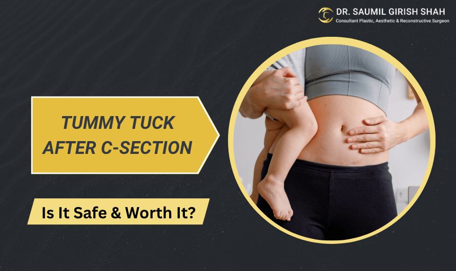 Tummy Tuck After C-Section: Is It Safe & Worth It?