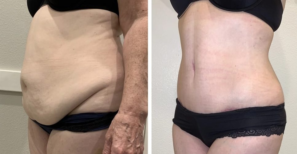 Tips Before Choosing Liposuction