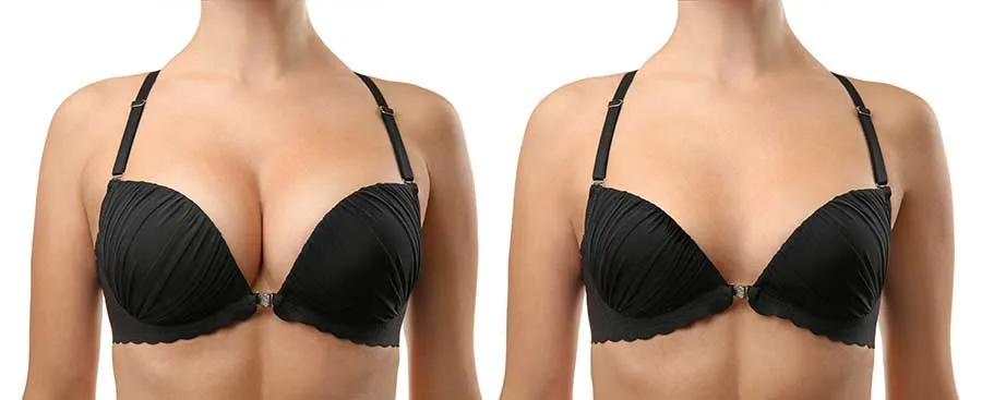 Understanding Breast Reduction Surgery in Mumbai with dr Saumil Shah