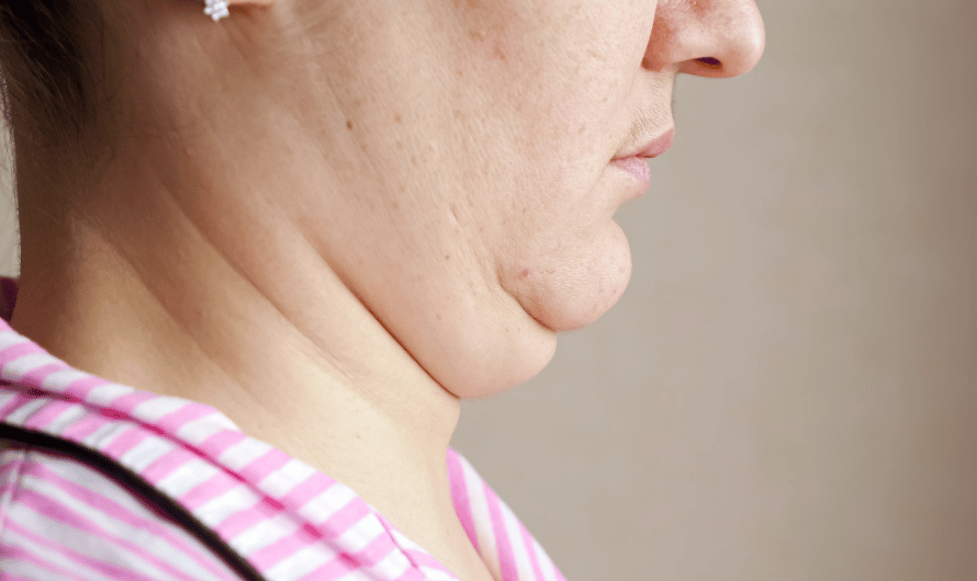 Understanding Double Chin Liposuction