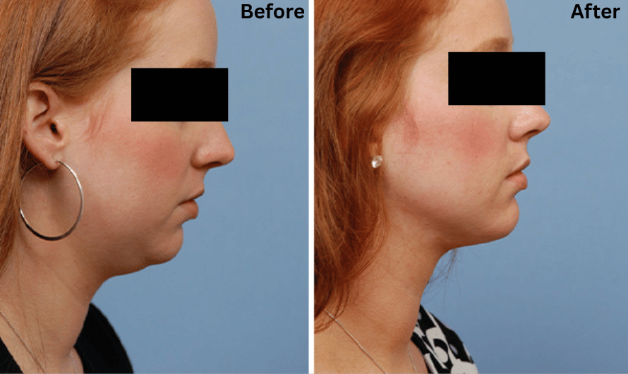 What is Double Chin Liposuction?