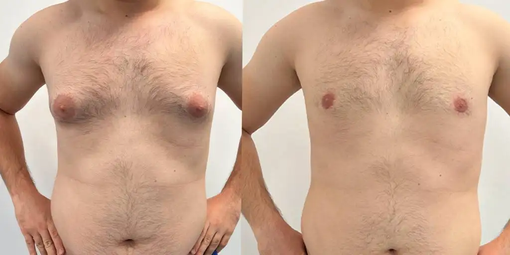 Gynecomastia in Mumbai by Dr. Saumil Shah