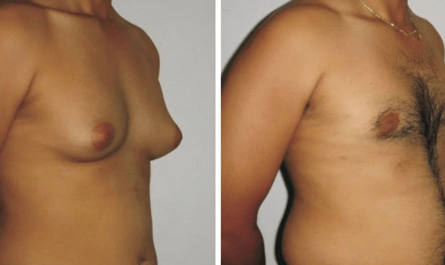 Gynecomastia surgery in Mumbai by Dr. Saumil Shah