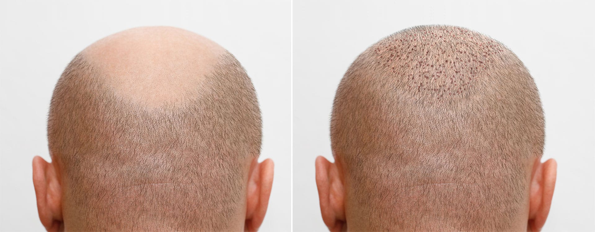 What is Hair Transplant?