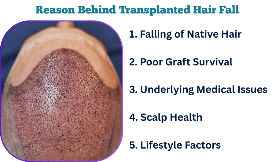 Why Does Transplanted Hair Fall Out After Two Years?
