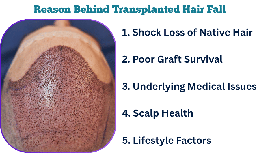 Why Does Transplanted Hair Fall Out After Two Years?