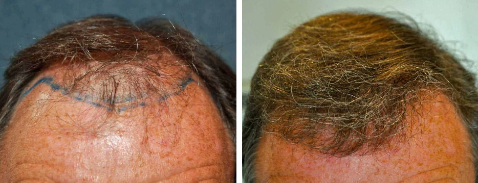 hair transplant