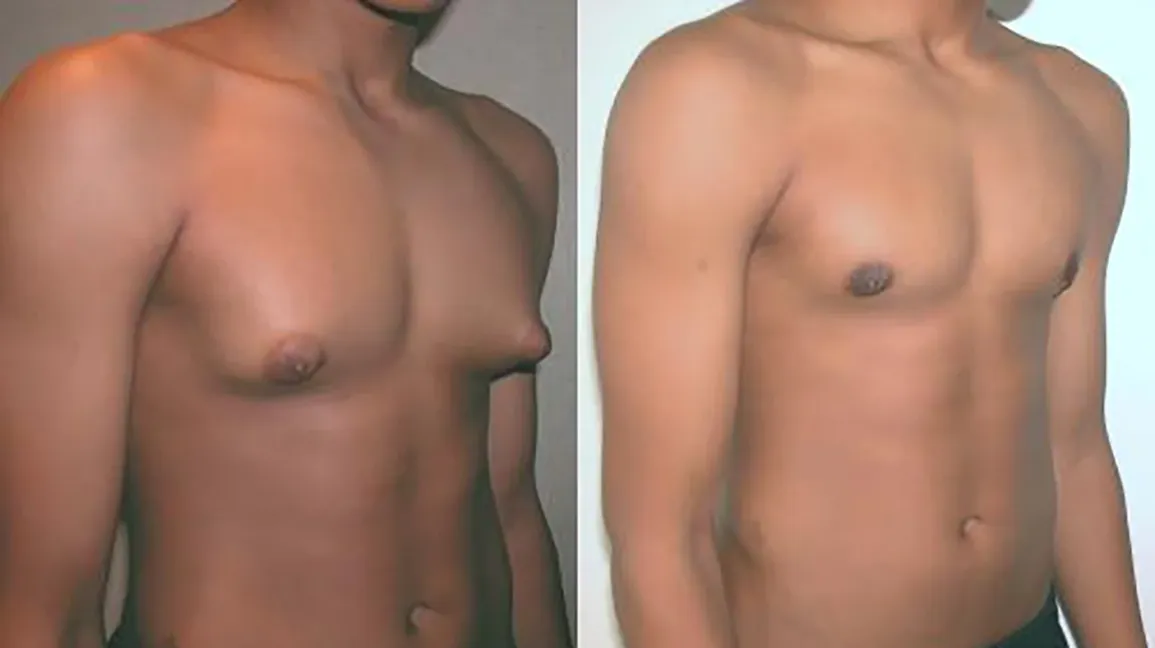 What is Gynecomastia?